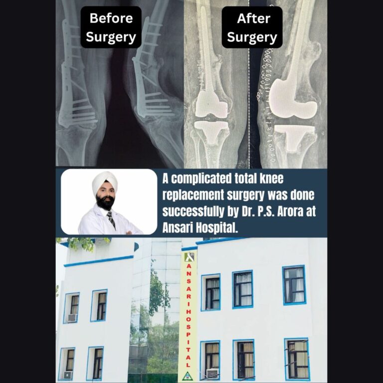Total Knee Replacement (TKR) Surgery by Dr. P.S. Arora at Ansari Hospital: A Step Toward Pain-Free Mobility