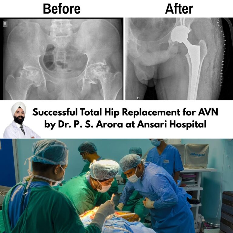 Successful Total Hip Replacement for Avascular Necrosis (AVN) by Dr. P. S. Arora at Ansari Hospital